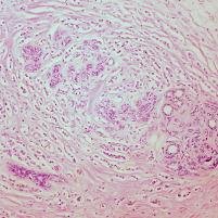File:Classic Invasive Lobular Carcinoma of the Breast (6959258373).jpg